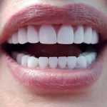 Ce ar trebui sa stim despre coroane dentare inainte de a apela la aceasta procedura